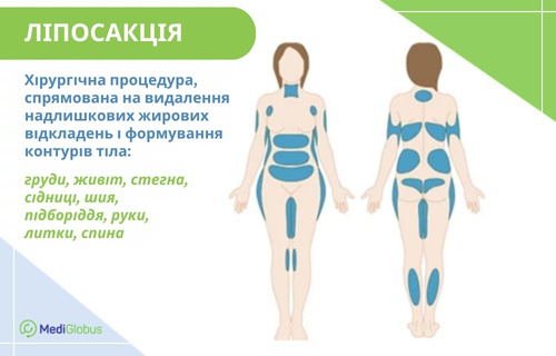 Що таке ліпосакція і які ділянки тіла можна коригувати за її допомогою Інфографіка про ліпосакцію та про те, які зони тіла можна коригувати за її допомогою