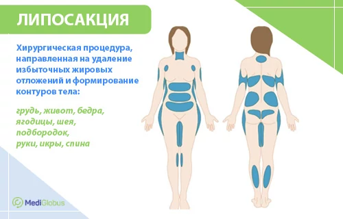 классическая липосакция