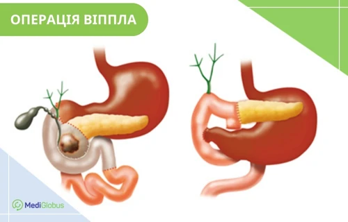 проведення операції Уіппла ліворуч — органи шлунково-кишкового тракту та підшлункова залоза, уражена пухлиною, до операції Віппла; праворуч — органи шлунково-кишкового тракту та підшлункова залоза після операції Віппла