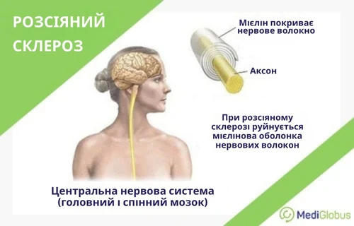 Пошкодження нервів під час розсіяного склерозу Медична інфографіка про розсіяний склероз. Показано людину з виділеними головним і спинним мозком, а також схематичне зображення нервового волокна, на якому позначено аксон і мієлінову оболонку, що руйнується при цьому захворюванні.