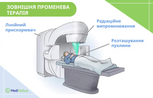 Методи променевої терапії: зовнішня радіотерапія Схематична ілюстрація процесу зовнішньої променевої терапії: пацієнт лежить на кушетці лінійного прискорювача; з головної частини апарату на ділянку живота пацієнта спрямовано конусоподібний промінь зеленого кольору, що позначає випромінювання.