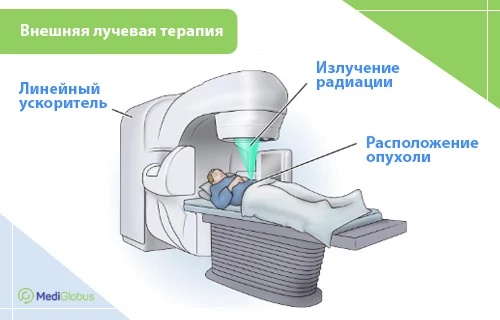 лучевая терпапия при метастазах