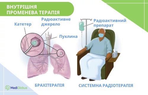 Методи внутрішньої променевої терапії Схематичне зображення двох методів внутрішньої променевої терапії. Зліва показано схему брахітерапії легенів, де за допомогою катетера радіоактивне джерело підводиться безпосередньо до пухлини. Справа зображено системну радіотерапію, під час якої пацієнту, що сидить у кріслі, через крапельницю внутрішньовенно вводиться радіоактивний препарат.
