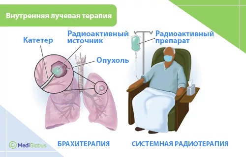 лучевая терпапия при метастазах