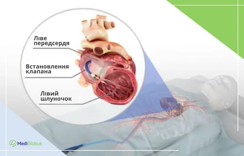 Як проводиться операція на клапанах серця На медичній ілюстрації зображено пацієнта на операційному столі та анатомічну схему зрізу серця з імплантованим клапаном