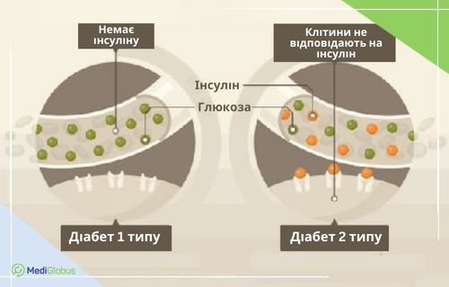 Лікування діабету 1 та 2 типу стовбуровими клітинами Медична схема, що порівнює діабет 1-го та 2-го типу