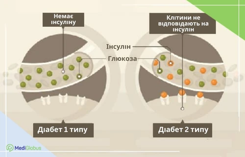 Лікування діабету 1 та 2 типу стовбуровими клітинами Медична схема, що порівнює діабет 1-го та 2-го типу