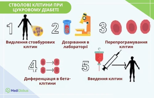 Інфографіка, що ілюструє етапи застосування стовбурових клітин при цукровому діабеті