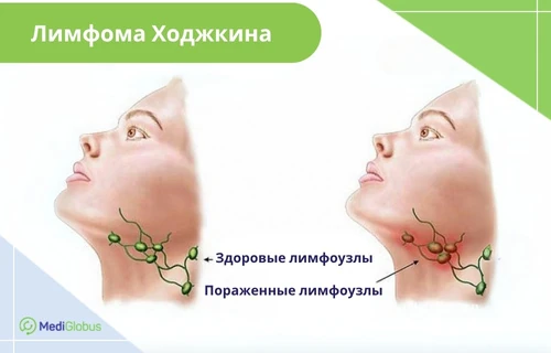 что такое лимфома ходжкина