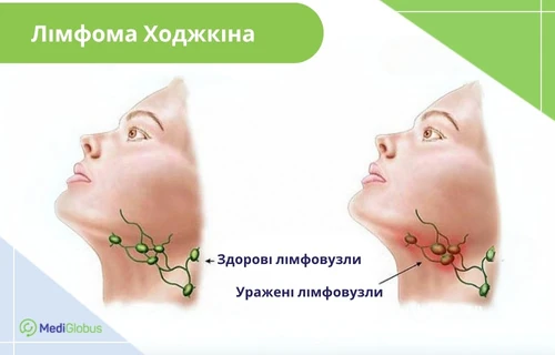 What-is-Hodgkin's-lymphoma-uk що таке лімфома ходжкіна