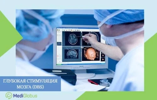 Глубокая стимуляция мозга Процесс планирования или анализа результатов в ходе процедуры глубокой стимуляции мозга (DBS — Deep Brain Stimulation), когда врачи смотрят на компьютерный монитор с изображениями сканирования головного мозга