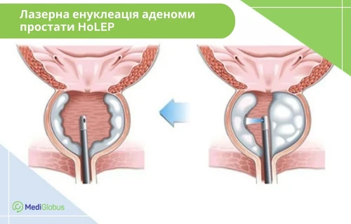 Лікування аденоми лазером Схематичні зображення етапів лазерної енуклеації аденоми простати методом HoLEP