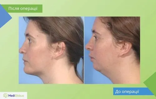 Операція зі збільшення кістки щелепи фото до та після операції зі збільшення щелепи