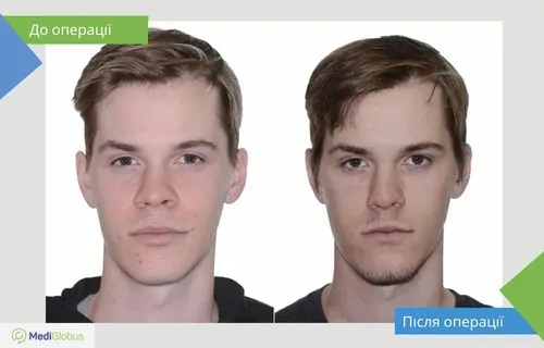 Операція з корекції нижньої третини обличчя фотографія до та після операції з корекції нижньої третини обличчя