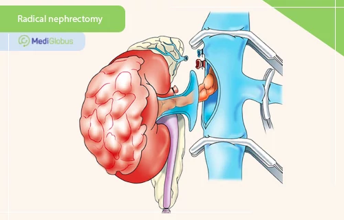 radical nephrectomy for clear cell renal sarcoma