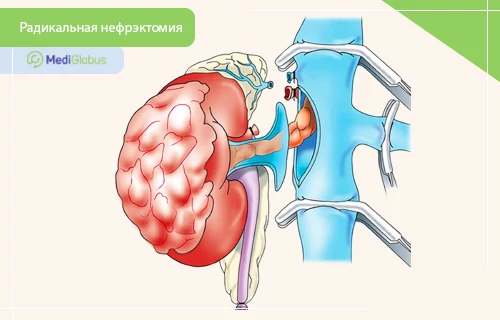 светлоклеточная саркома почки