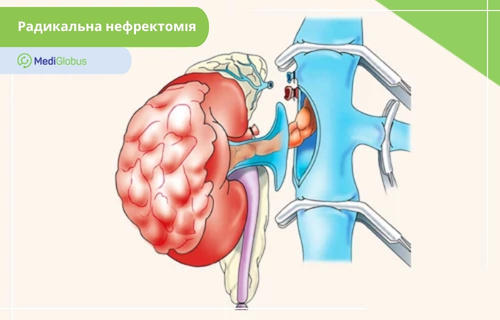 Операція при світлоклітинній саркомі нирок Медична ілюстрація процесу радикальної нефректомії. На схемі зображено нирку з великою пухлиною на її поверхні. Ниркові судини перетиснуті хірургічними затискачами та відсікаються від нижньої порожнистої вени.