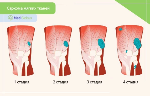 светлоклеточная саркома мягких тканей