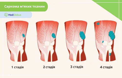 Стадії саркоми м'яких тканин Ілюстрація 4-х стадій саркоми м’яких тканин на прикладі анатомічного розрізу ноги, що демонструє поступове збільшення вогнища пухлини від невеликого локалізованого вузла на першій стадії до великого новоутворення з метастазами на 4-й стадії.