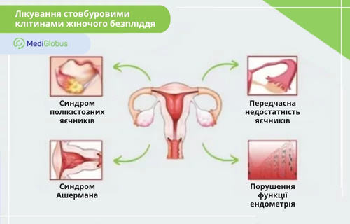 Лікування жіночого безпліддя Інфографіка на тему застосування стовбурових клітин у лікуванні жіночого безпліддя. На схемі зображено матку та яєчники, від яких стрілки ведуть до чотирьох патологій: синдром полікістозних яєчників, синдром Ашермана, передчасна недостатність яєчників та порушення функції ендометрія.