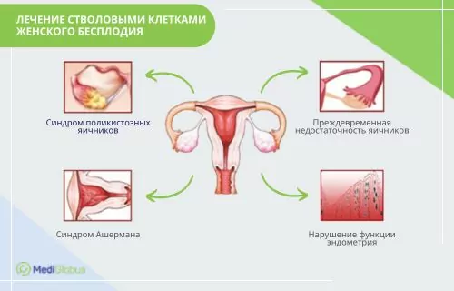женское бесплодие лечение
