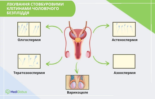 Лікування чоловічого безпліддя Схема «Лікування чоловічого безпліддя стовбуровими клітинами», на якій від центрального зображення чоловічої репродуктивної системи відходять стрілки до п’яти патологій: олігоспермії, астеноспермії, тератозооспермії, азооспермії та варикоцеле, кожна з яких проілюстрована схематичною мініатюрою.