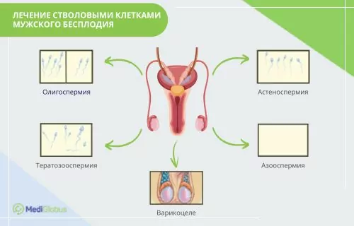 бесплодие у мужчин