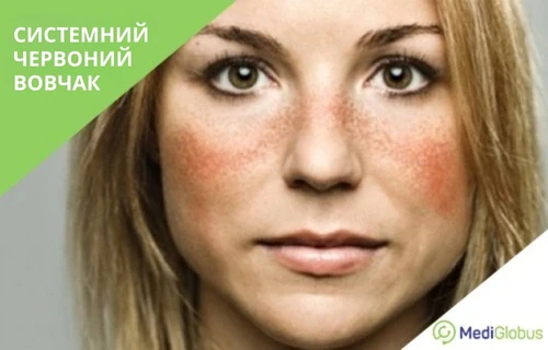 Sustemnaya-krasnaya-volchanka-uk лікування системного красного вовчаку