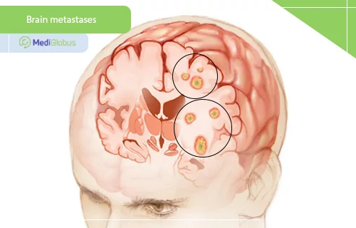 Chemotherapy for brain metastases