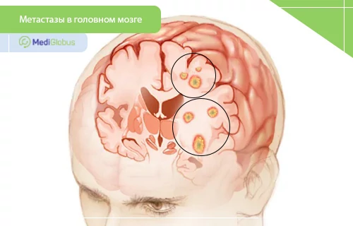 химиотерапия при метастазах головного мозга