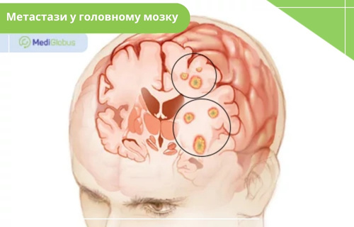 Метастази в головному мозку Медична ілюстрація головного мозку людини в розрізі. На схемі чорними колами виділено численні округлі вогнища жовто-помаранчевого кольору з чітким контуром, які наочно демонструють метастази (вторинні пухлини) у тканинах мозку.