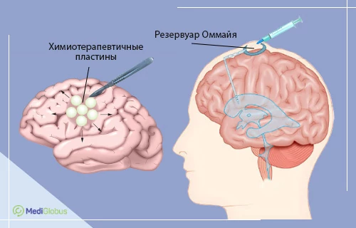 химиотерапия после удаления опухоли головного мозга