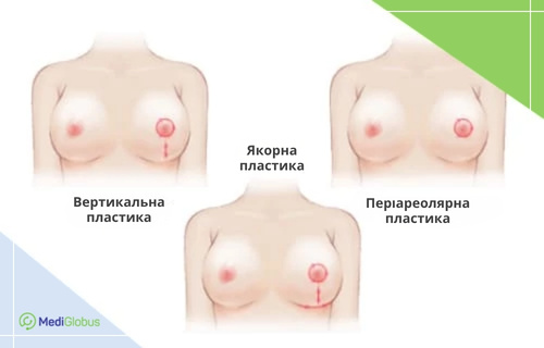 Схеми розрізів під час операцій зі зменшення грудей: вертикальний, якірний та періареолярний