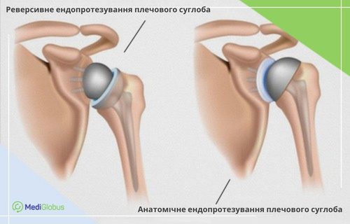 порівняння реверсивного та анатомічного ендопротезування плечового суглоба