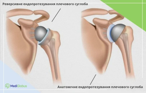 техніки ендопротезування плечового суглоба порівняння реверсивного та анатомічного ендопротезування плечового суглоба