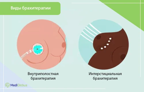 брахитерапия рака молочной железы