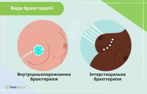 Види брахітерапії при раку молочної залози Інфографіка «Види брахітерапії»: ліворуч — внутрішньопорожнинна брахітерапія молочної залози з використанням балонного катетера в ложі пухлини, праворуч — інтерстиціальна брахітерапія з введенням голок-катетерів безпосередньо в тканини грудей.