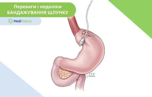 Бандажування шлунка Зображення органів ШКТ після бандажування шлунка