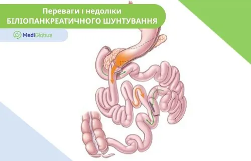 Біліопанкреатичне шунтування Зображення органів ШКТ після біліопанкреатичного шунтування