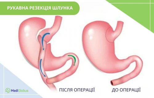 Sleeve-gastric-resection-uk Рукавна гастропластика за кордоном