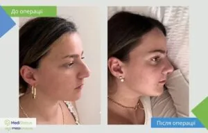 Ринопластика - робота Чарі Саде Чарі Саде фото до після ринопластики