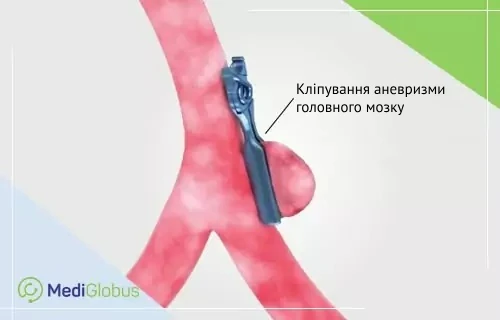 лікування аневризми мозку 3D-зображення кліпування аневризми