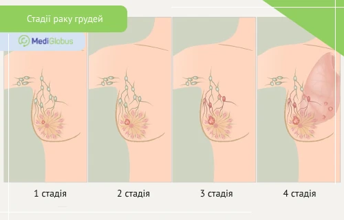 стадії раку молочної залози схематичні зображення 1-4 стадій розвитку раку молочної залози з поступовим ураженням навколишніх тканин і лімфовузлів