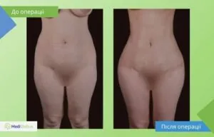 Ліпосакція - робота Бюлента Джихантімура Ліпосакція фото до після Бюлент Джихантімур