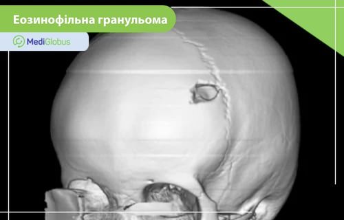 Тривимірна візуалізація черепа з дефектом кісткової тканини