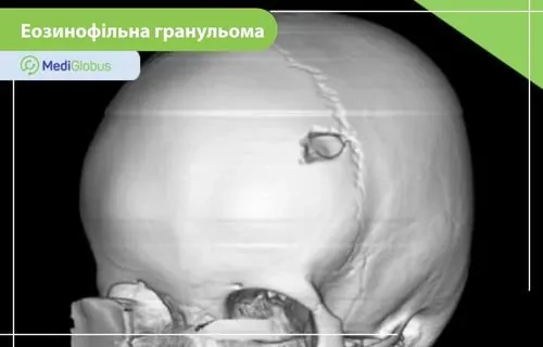 Еозинофільна гранульома — приклад ураження кісток, що виявляється під час діагностики захворювання Тривимірна візуалізація черепа з дефектом кісткової тканини