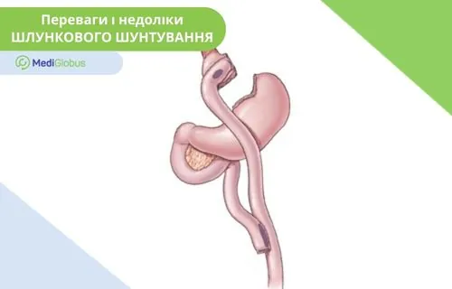 Шлункове шунтування Зображення шлугку після шунтування