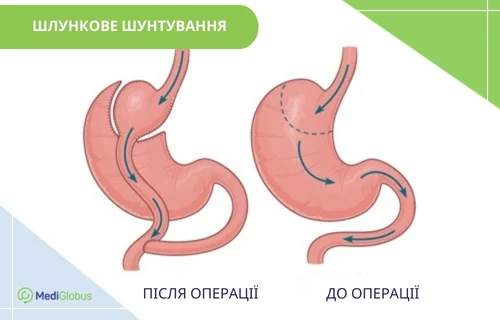 gastric-bypass-uk шунтування шлунка за кордоном