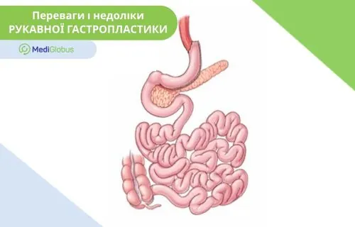 Рукавна гастропластика Зображення органів ШКТ після рукавної гастропластики
