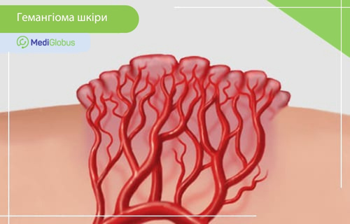 анатомічна ілюстрація гемангіоми шкіри та її будови